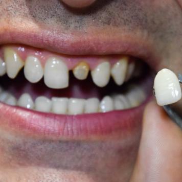 Costo corona dentale resina - Come scegliere quella giusta