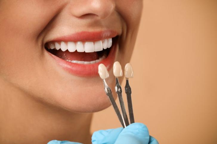 Faccette dentali vip