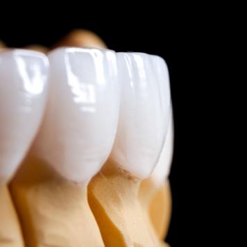 Corona impianto dentale