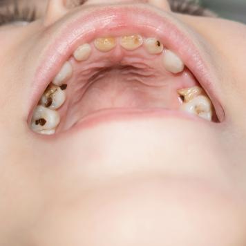 Denti rovinati