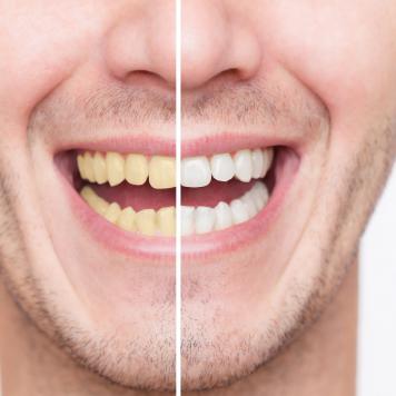 Denti gialli rimedi