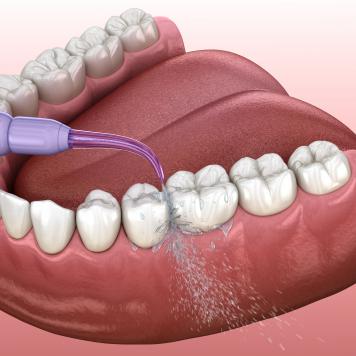Idropulsore professionale