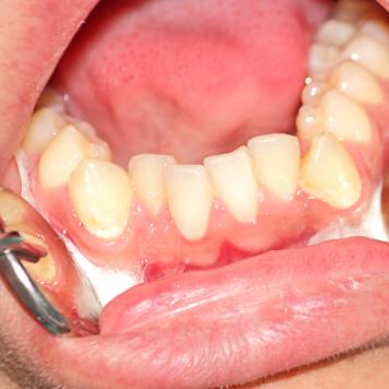 Denti storti bambini