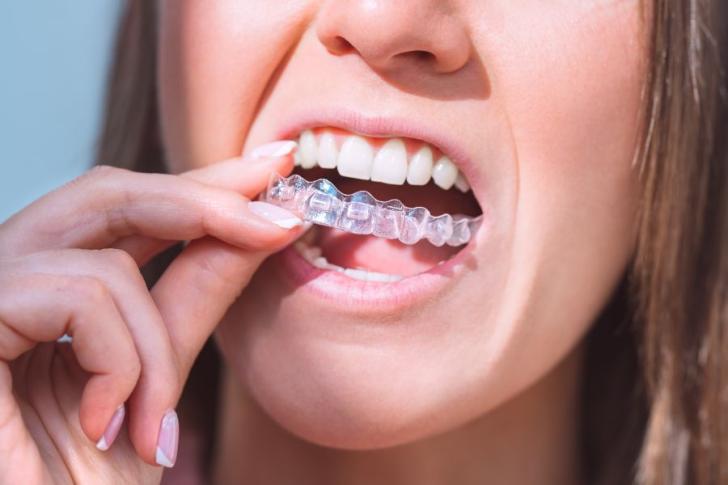 Invisalign opinioni