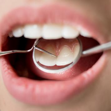 Dente devitalizzato nero