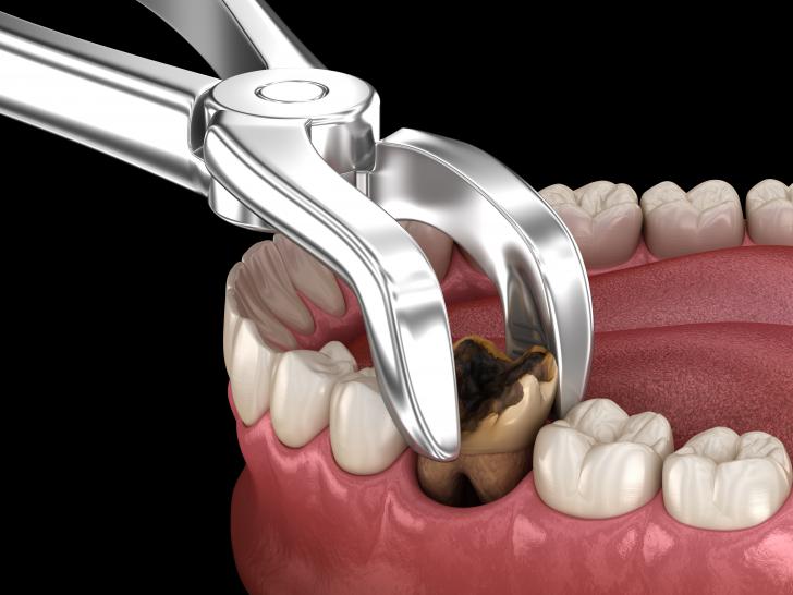 Dente devitalizzato nero