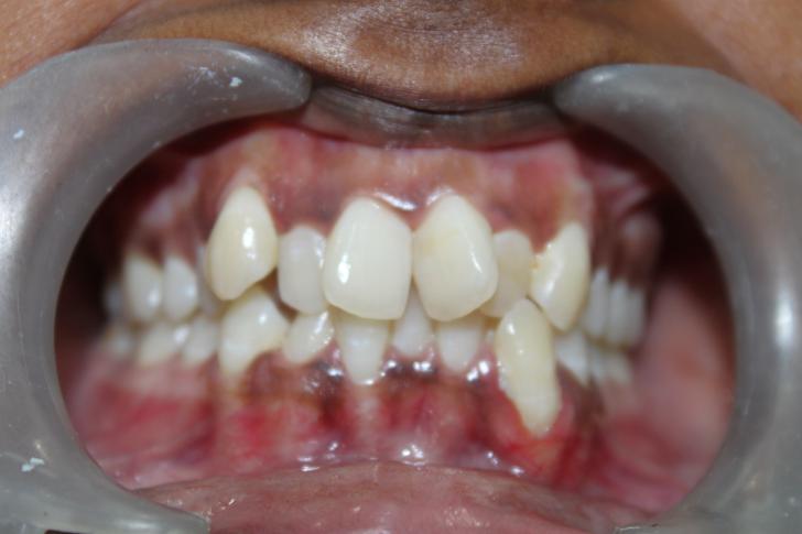 Affollamento dentale grave
