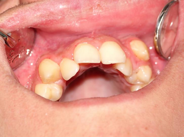Affollamento dentale