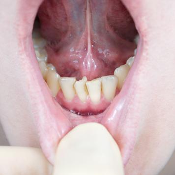 Affollamento dentale grave