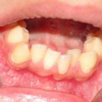 Affollamento dentale
