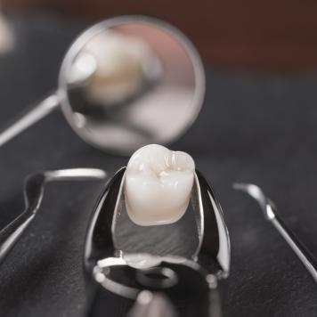 Coagulo bianco dopo estrazione dente