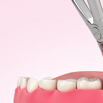 Cosa mangiare dopo estrazione dente