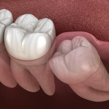 Crescita dente del giudizio
