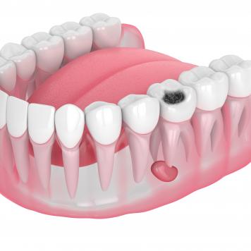 Dente cariato rotto