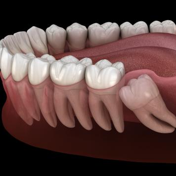 Dente del giudizio quando esce