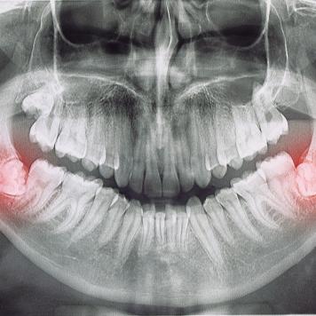 Dente del giudizio storto