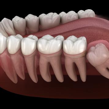 Dente del giudizio