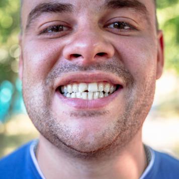 Dente rotto