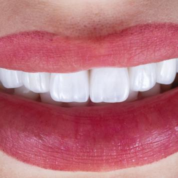 Denti rifatti prima e dopo