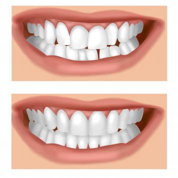 Denti storti