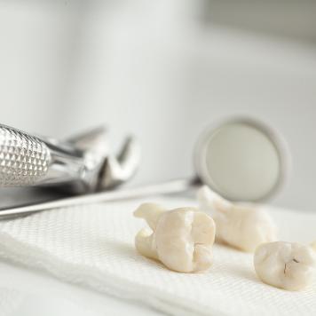 Dolore dopo estrazione dente molare