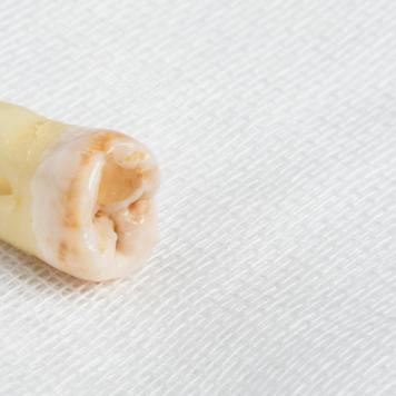 Estrazione dente del giudizio superiore fa male