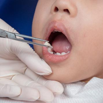 Estrazione dente ghiaccio