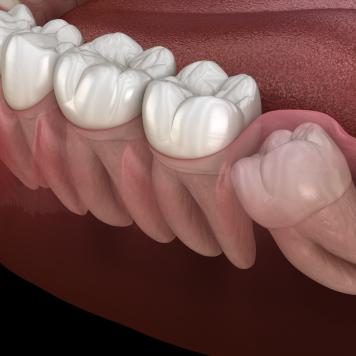 Quanti sono i denti del giudizio