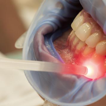 Ricostruzione gengivale laser