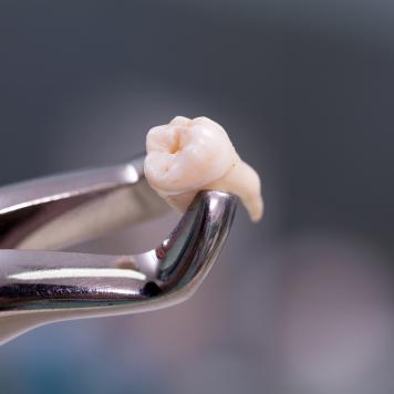 Si può togliere un dente con infiammazione
