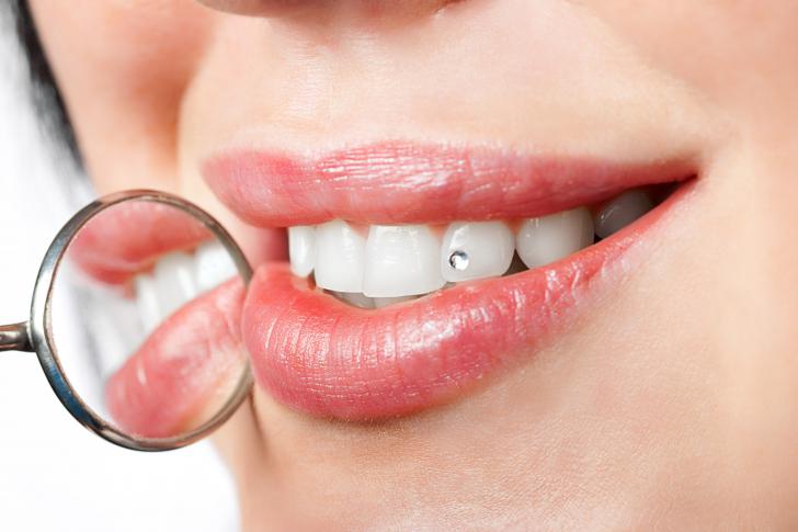 Brillantino al dente costo
