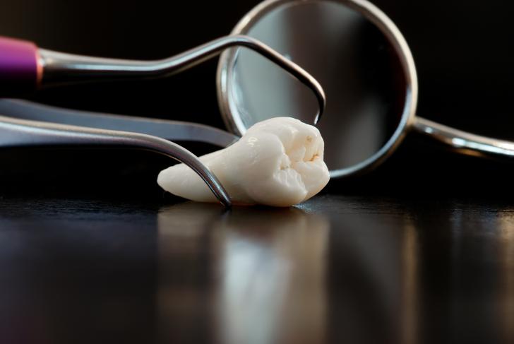 Coagulo bianco dopo estrazione dente 