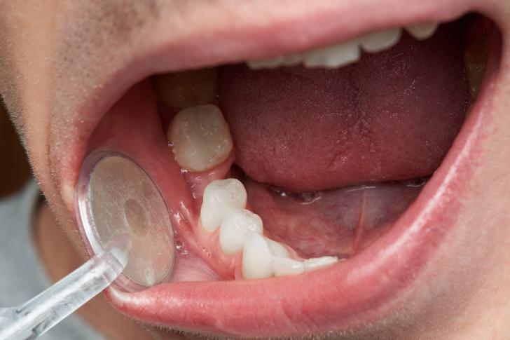 Come nascondere un dente mancante
