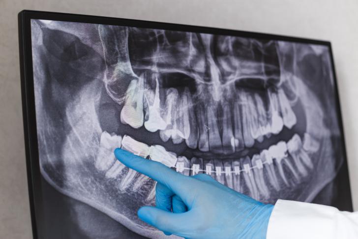 Crescita dente del giudizio