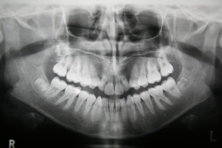Dente del giudizio età