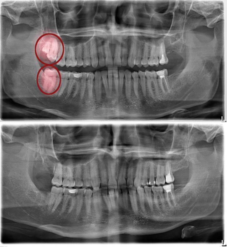 Dente del giudizio incluso
