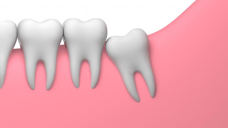 Dente del giudizio