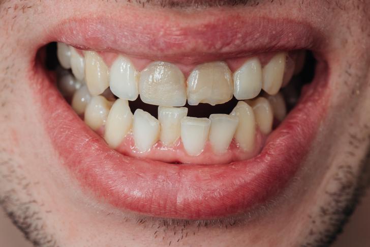 Dente scheggiato costo