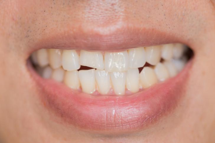 Dente scheggiato ricresce