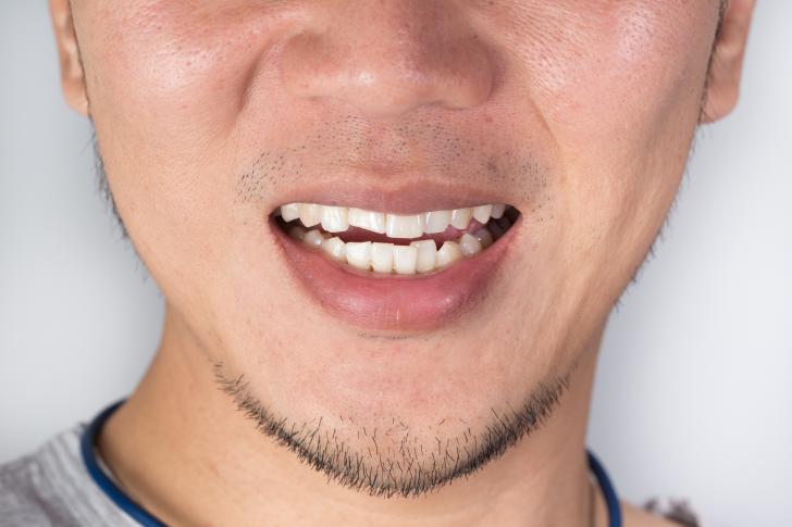 Dente scheggiato