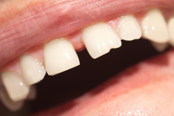 Dente spezzato si può attaccare