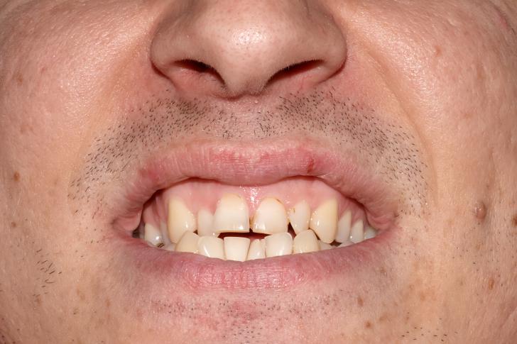 Denti accavallati