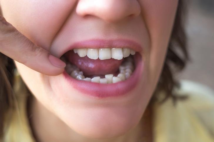 Denti storti
