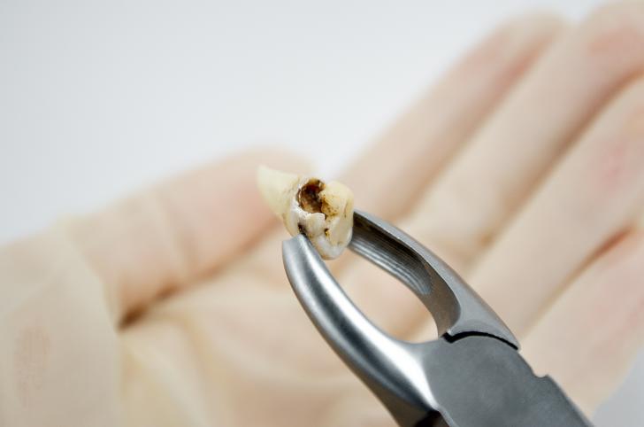 Estrazione dente del giudizio superiore cariato