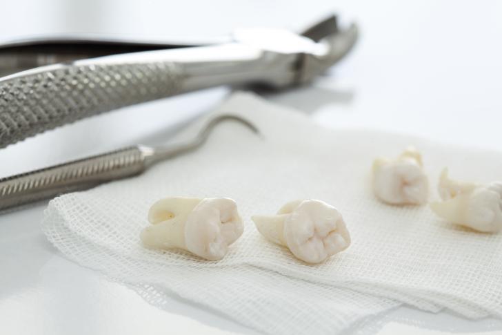 Fumare dopo estrazione dente
