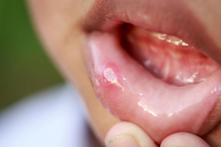 Lichen planus orale