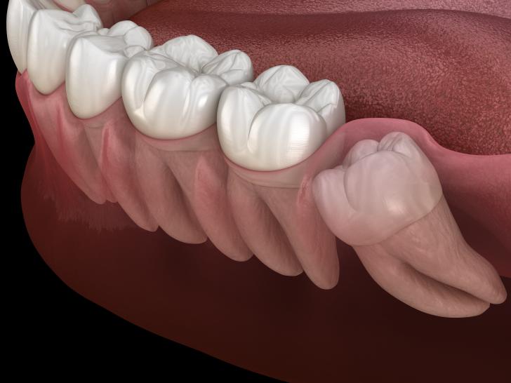 Quanti sono i denti del giudizio