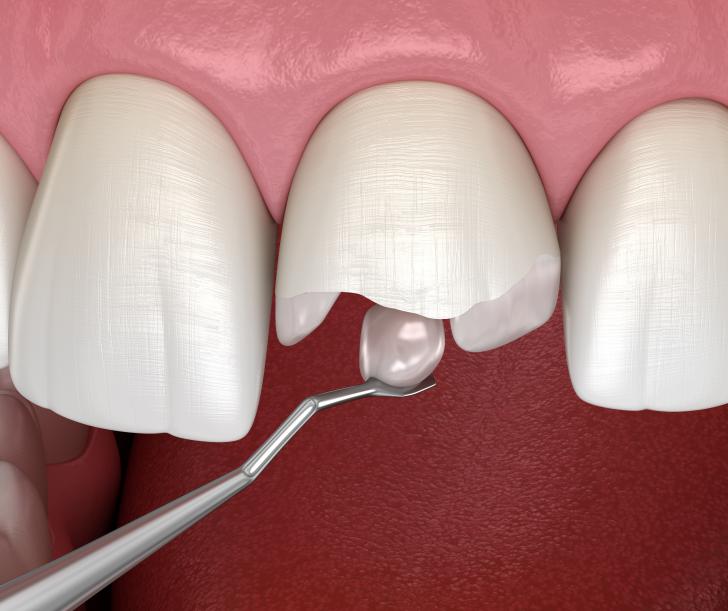 Quanto costa aggiustare un dente rotto