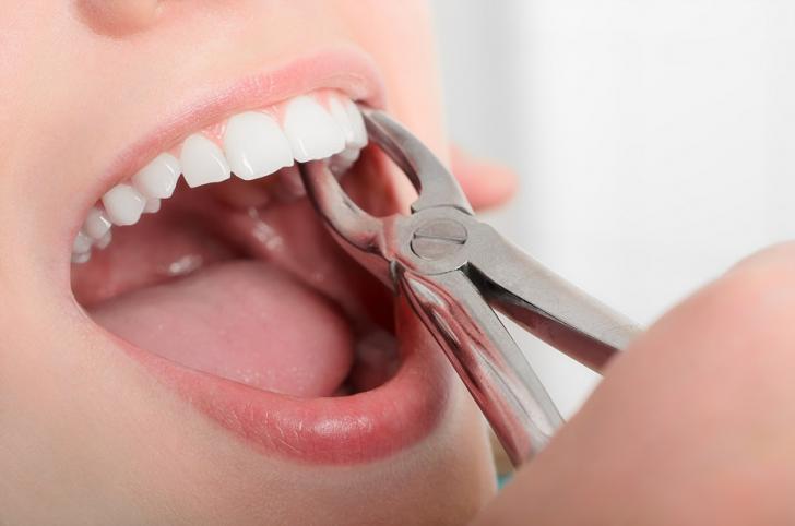 Tempi di guarigione dopo estrazione dente