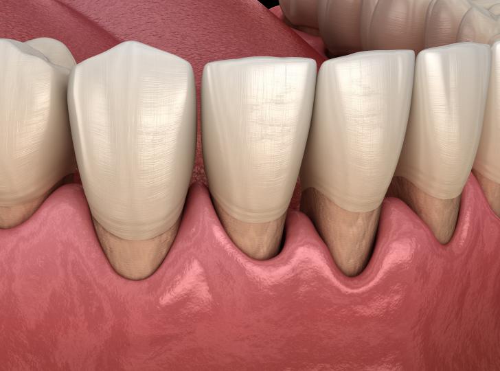 Bordo nero tra dente e gengiva